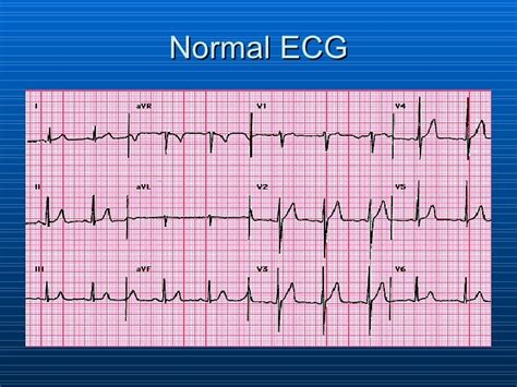 what does a normal ekg look like.
